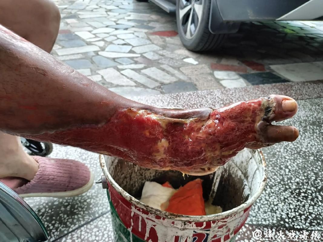 熏蒸足部竟致深度溃烂专家提醒: 糖尿病患者需警惕“温暖陷阱” 熏蒸足部竟致深度溃烂专家提醒: 糖尿病患者需警惕“温暖陷阱”